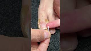 Toe Nail Fixer| Ingrown Toenail Cleaning & Care #ToenailFix #NailCare #FootCare #PedicureClean