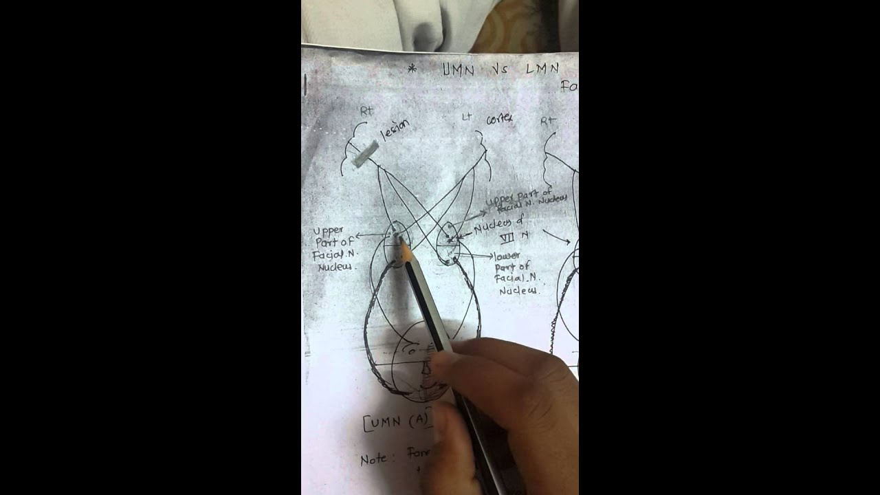 Facial nerve palsy UMN vs LMN simplified YouTube