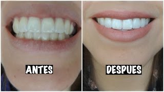 BLANQUEA TUS DIENTES Fácil y rápido | Adristyling ♡(Hola!!!! Hoy es sábado y como todos los sábados toca video nuevo!! Ayer fue mi último día con el kit de Crest 3D White Classic Vivid los whitestrips! En el video ..., 2015-09-27T03:36:23.000Z)