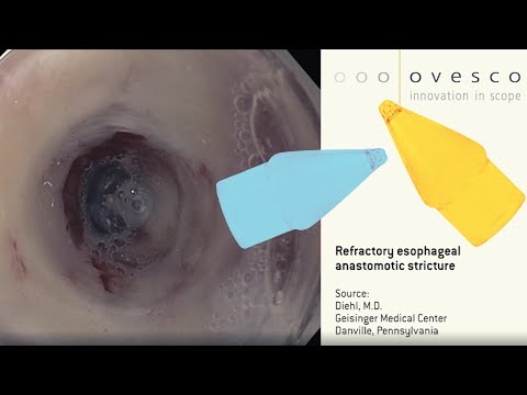 Бужирование рефрактерной стриктуры пищеводного анастомоза. Bougie Cap (Ovesco Ag)