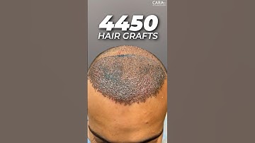 4450 Hair Grafts | Sapphire FUE Hair Transplant By Dr. Mohd Asif at CARA
