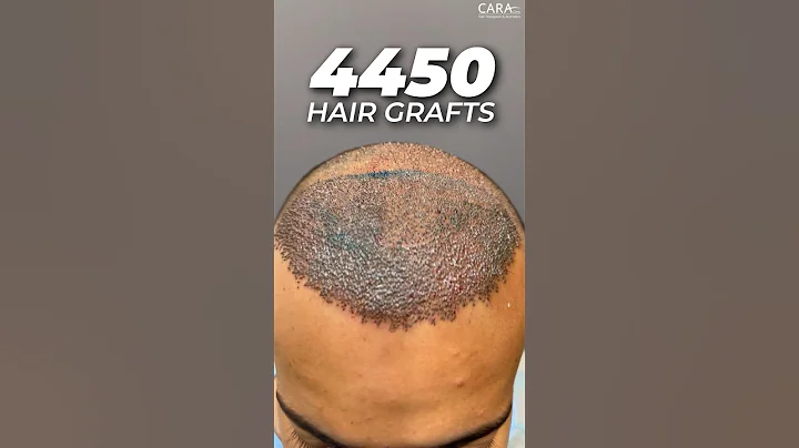 4450 Hair Grafts | Sapphire FUE Hair Transplant By Dr. Mohd Asif at CARA