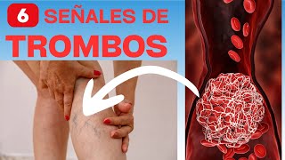 6 señales de que tendrás trombosis o coágulos