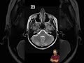 Characterizing brain lesions  thereportingroom