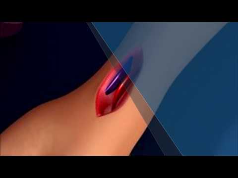 Video: Apa yang dimaksud dengan fistula av brakiosefalika?