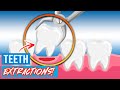 Tooth Extractions For Braces! | Why Do Orthodontists Extract Teeth?