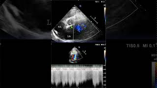 Fifth cardiac chamber Left circumflex artery fistula to the left atrium 2 #echocardiography