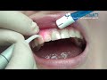 Как применяется лазер в стоматологии?