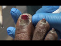 A nail trimming that was never published - thick fungal nails and calluses