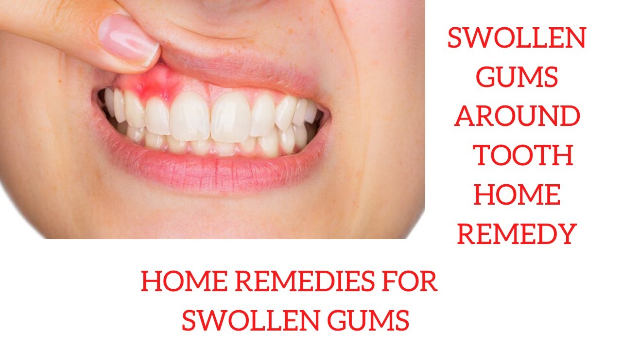 Home Remes To Heal Swollen Gums - Tutor Suhu