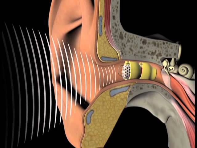 How the Lyric invisible hearing aid works