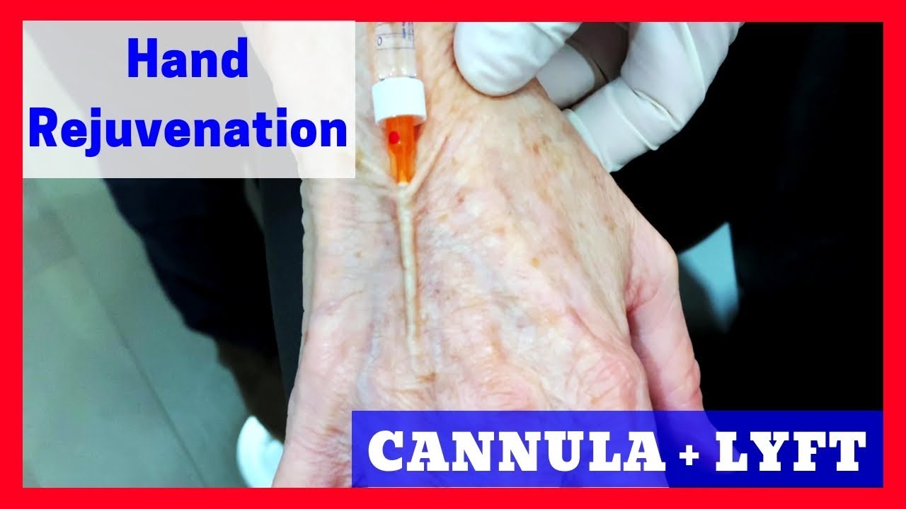 Hand Rejuvenation using Cannula + Restylane Lyft
