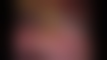 Robotic Xi Left Upper Lobe Apical Trisegmentectomy