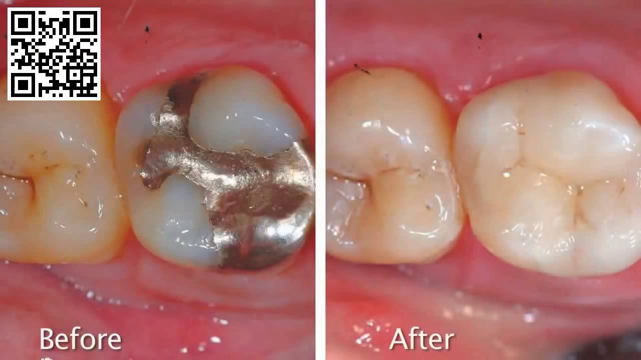 Cerec Dental Crown Machine • Wayland Dental