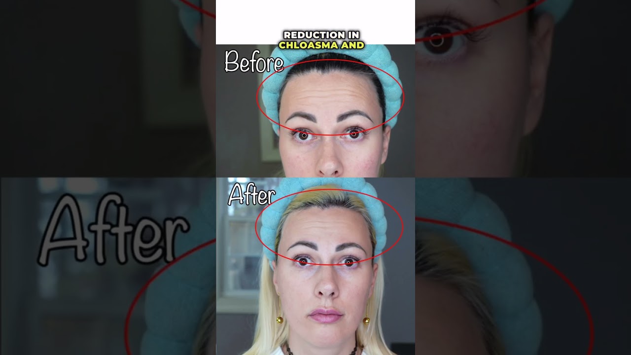 The Ultimate Laser Duo! DermRays Revive & V8S – Real Results! 