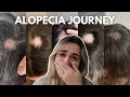 My journey with alopecia areata  q  a