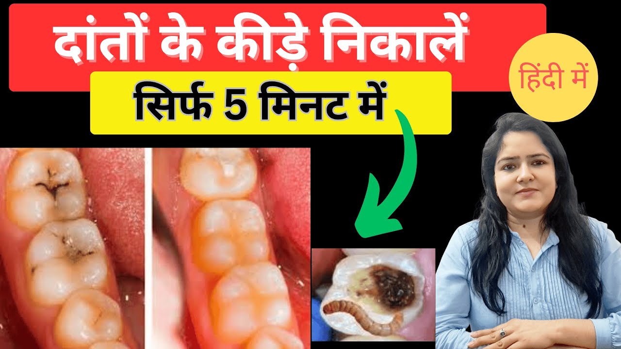 दांतों के कीड़े का इलाज | दांतों के दर्द का इलाज #toothdecay #cavityfilling #dentalcavity