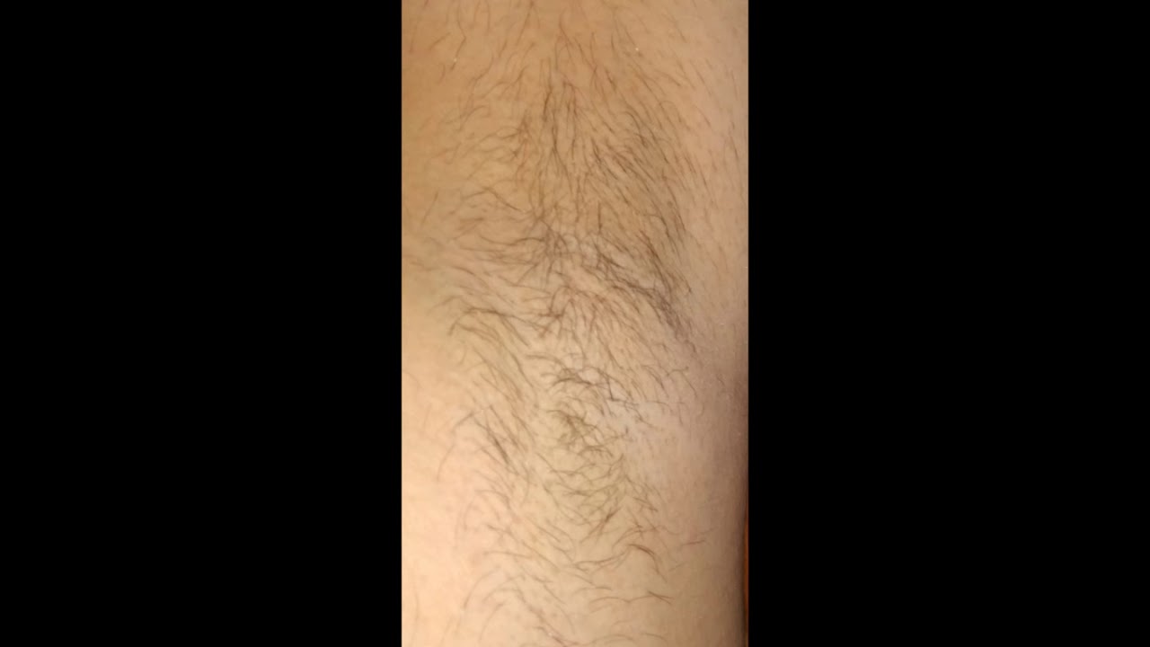 Armpit Hair Growth In 30 Days Timelapse Youtube
