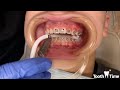 How braces are put on - 12 year old patient - Tooth Time Family Dentistry New Braunfels