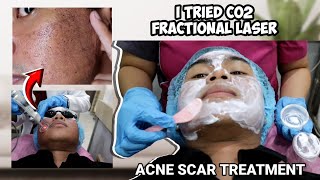 ACNE SCAR TREATMENT: I TRIED CO2 FRACTIONAL LASER | SUBCISION FOR ACNE SCARS