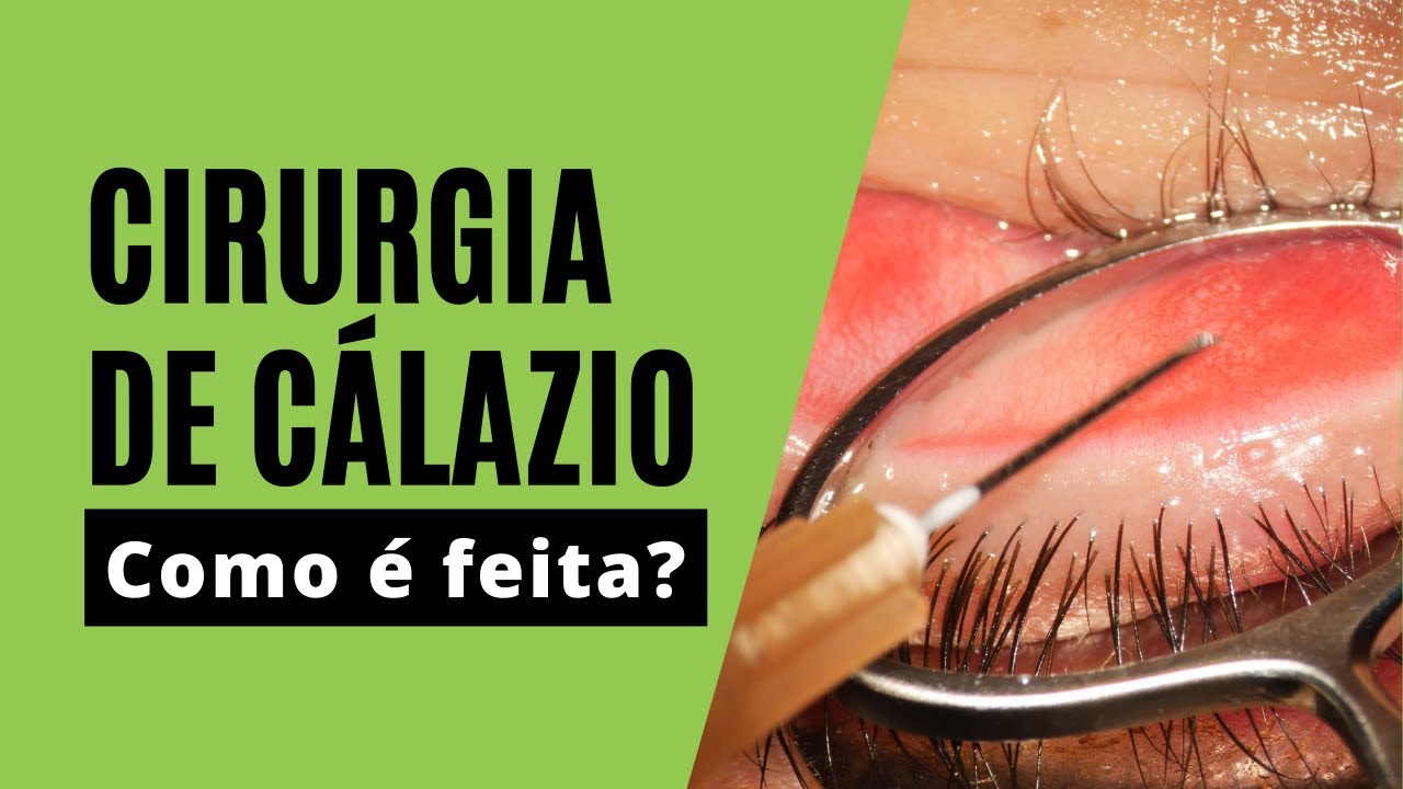 Cirurgia de Calázio - como é feita? 