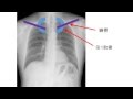 超実践的胸部X線写真講座肋骨の数え方
