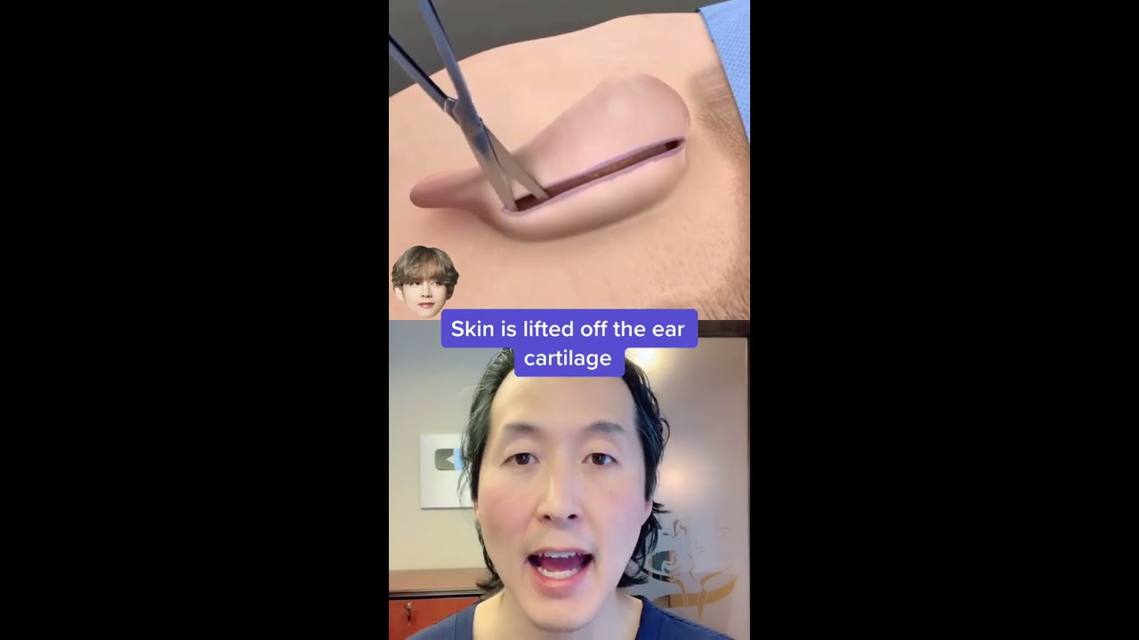 Watch How Ear Pinning Otoplasty Surgery Works Shorts