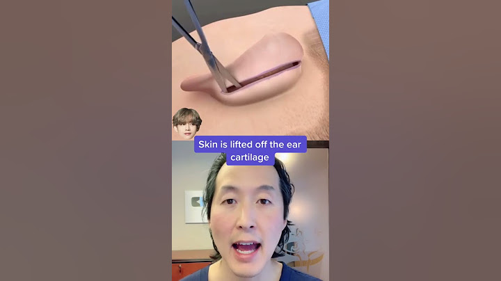 Watch How Ear Pinning (Otoplasty) Surgery Works! #shorts #otoplasty