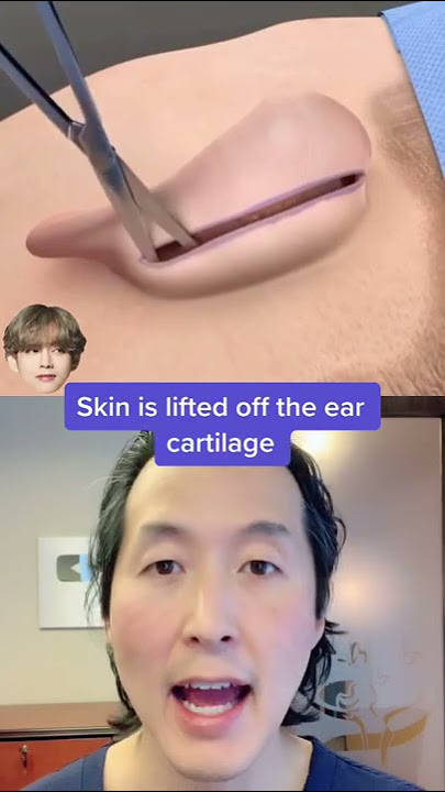 Watch How Ear Pinning (Otoplasty) Surgery Works! #shorts #otoplasty