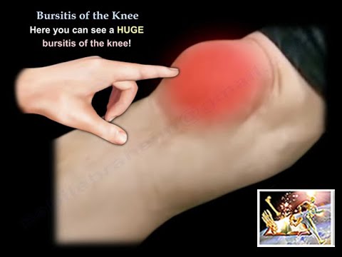 Video: Knee Bursitis - Symptoms, Treatment, Causes