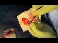 Ipospadia fallita: Informazioni e Trattamenti Avanzati" @ruffoandrology