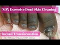 👣 XOX Excessive Never Ending Dead Skin Cleaning Big Toenail Transformation Pedicure Tutorial