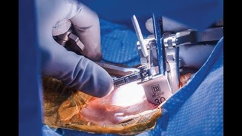 Phantom CS: Evolving MIS Surgical Access to the Cervical Spine | Featuring Dr. Ashish Sahai