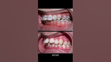 Niềng răng hô 24 tháng #braces #orthodontist #niengrang