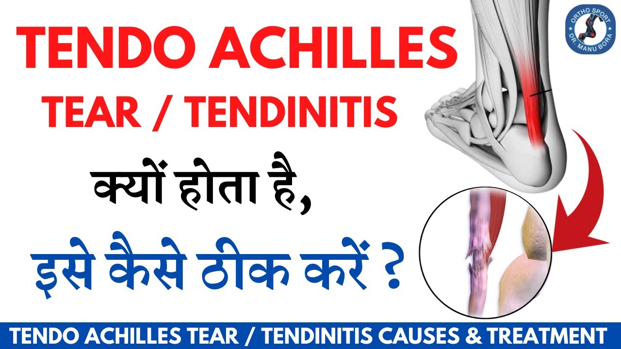 Tendo Achilles Tear, Tendinitis क्यों होता है, कैसे ठीक करें? Achilles