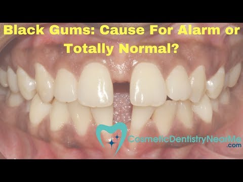 Black Gums: Sign of a Problem or Completely Normal?
