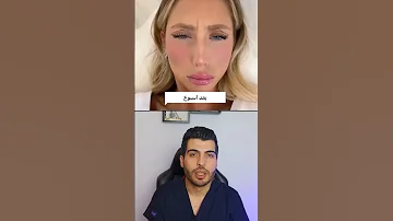 تأثير حقن البوتوكس ع الوجه حقن بوتكس حقن الفيلر بوتوكس بوتوكس فيلر ديرمارولر النساء د مصعب حسوا 