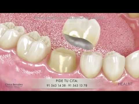 Vídeo: Prótesis De Corona Dental