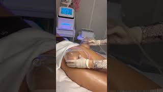 Vacuum therapy  #aesthetic #beauty #vacuum #bodytransformation #bodycontouring #body Profile