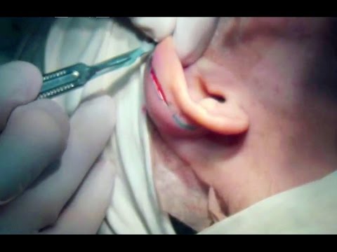 Корекція складеної вушної раковини|Constricted ear correction|Коррекция сложенной ушной раковины