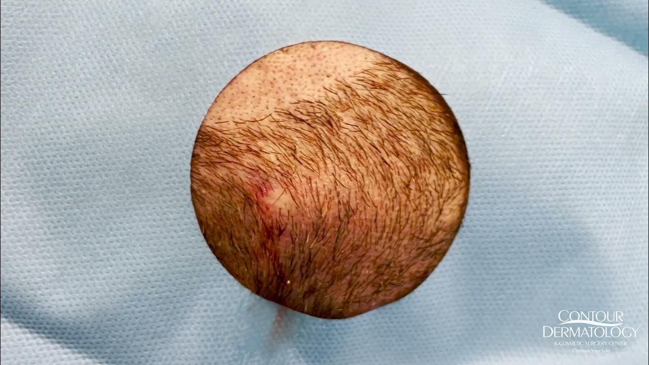 Draining an Infected Cyst (Cyst Popping) CONTOUR DERMATOLOGY YouTube(07)