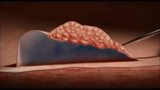 Endoscopic Mucosal Resection EMR of Polyps Animation - English