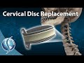 Cervical Disc Replacement