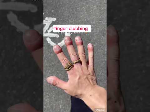 علامة غريبة في الأصابع تكشف أمراض خطيرة 