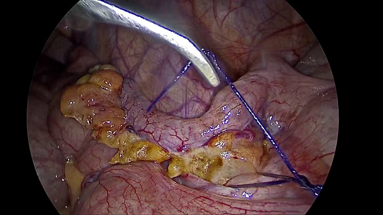 Laparoscopic Appendectomy YouTube