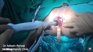 TRRPCS  | 6 Stapler Surgery For RECTAL Prolapse | Procidentia | Genital Prolapse by Dr Ashwin Porwal