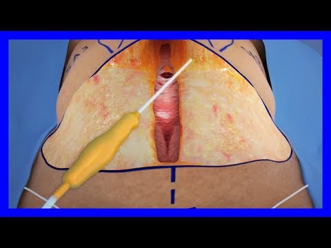 Video: Abdominoplasti Perut - Ulasan, Sebelum Dan Sesudah