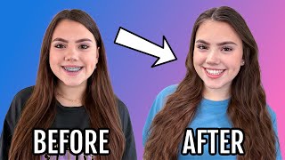 Gracelynn Finally Gets Her Braces Off Before And After