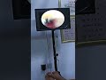 耳垢そうじ/耳が痒くなった鼓膜に付着した軟耳垢/#shorts