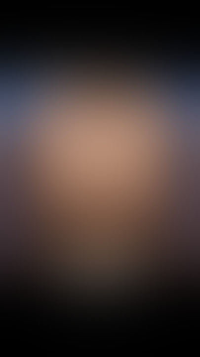 No implant autoaugmentation AWAKE BREAST LIFT®️ before and one day after.